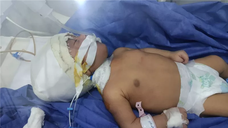 مستشفى طلخا المركزي ينجح فى تركيب صمام مخ خارجي لطفل عمره 35 يومًا