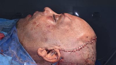  بعد 40 يوما من حادث صعب.. مستشفى شربين المركزي يعيد بناء وجه مريض