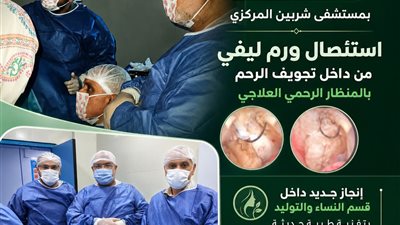 نجاح استئصال ورم ليفي من الرحم بالمنظار لأول مره بمستشفى شربين 