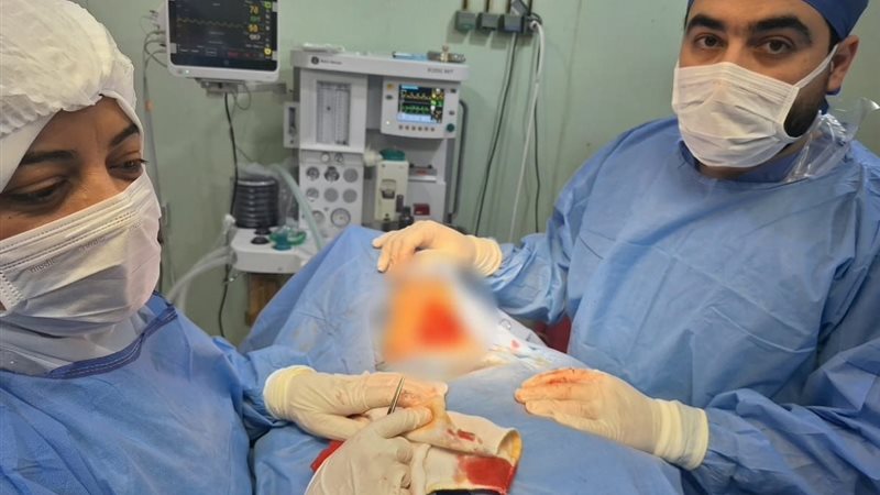 استئصال تضخم بالغدة
