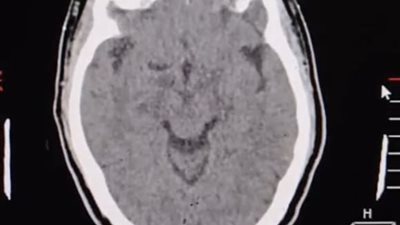 تدخلات عاجلة بمستشفى السنبلاوين العام تنقذ 3 مرضى من مضاعفات.. تفاصيل 