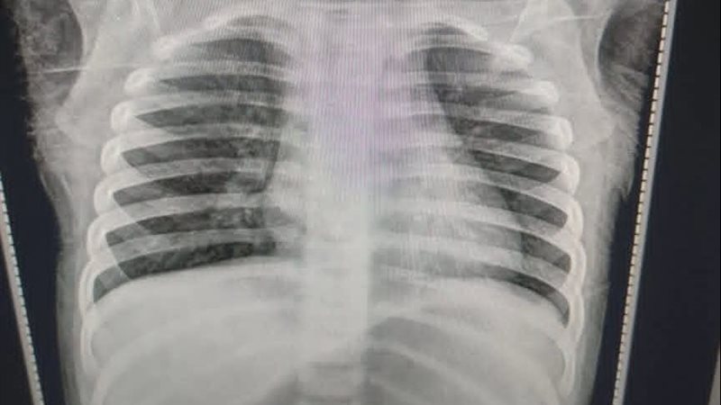 إنقاذ رضيع من الموت