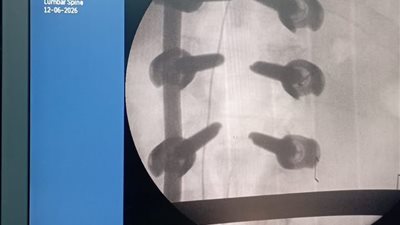 تمي الأمديد المركزي يواصل نجاحاته الطبية بجراحة دقيقة وعلاج جلطة في الوقت الذهبي