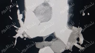 بين الحياة والموت 5 مرات.. ملحمة طبية داخل «طوارئ أشمون العام» تكللت بالنجاح