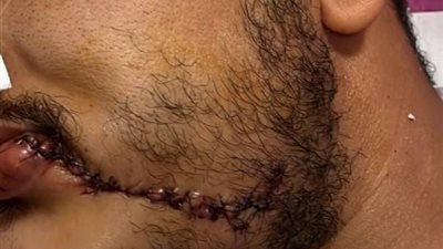جراحو الوجه والفكين ينقذون شاباً من نزيف حاد بمستشفيات سوهاج الجامعية