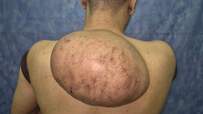 15 كجم.. جراحة دقيقة تستأصل ورماً دهنياً ضخماً من ظهر مريض بسوهاج