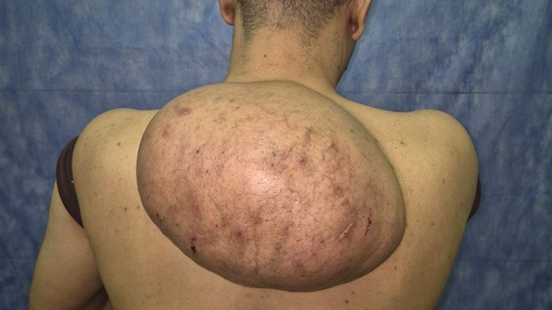 نجاح إزالة ورم دهني