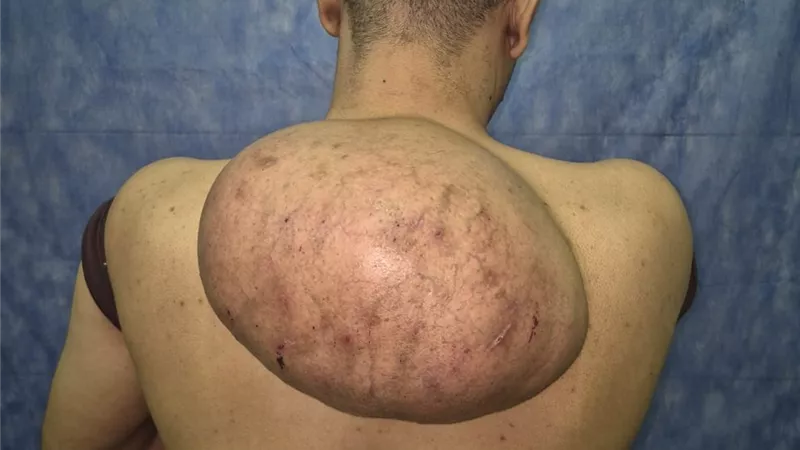 15 كجم.. جراحة دقيقة تستأصل ورماً دهنياً ضخماً من ظهر مريض بسوهاج